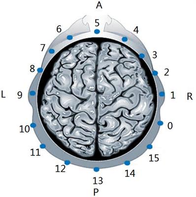 Exploratory study of a multifrequency EIT-based method for detecting intracranial abnormalities